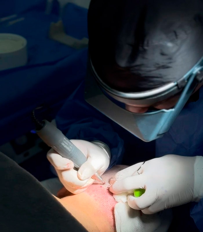 Los Reyes del Injerto - Injerto Capilar