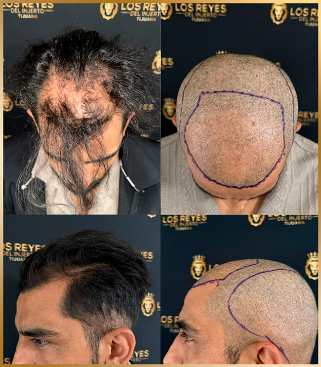 Los Reyes del Injerto - diagnostico para Injerto