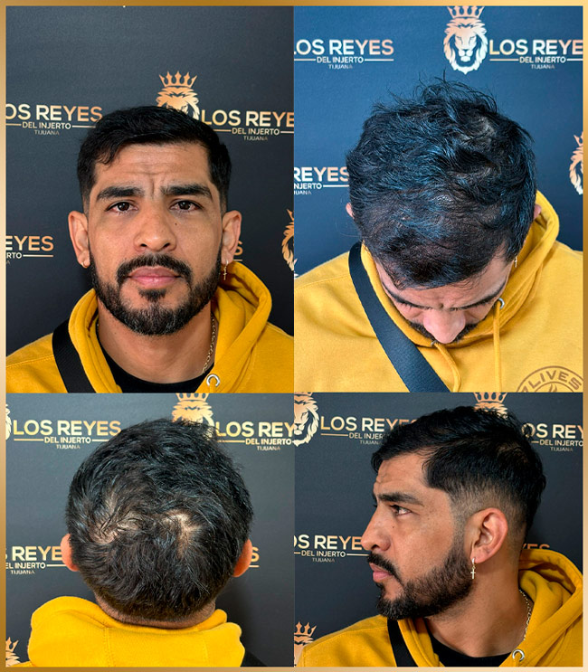 Los Reyes del Injerto - Injerto 4 meses despues