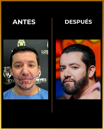 Los Reyes Del Injerto - Testimonio injerto de barba 13