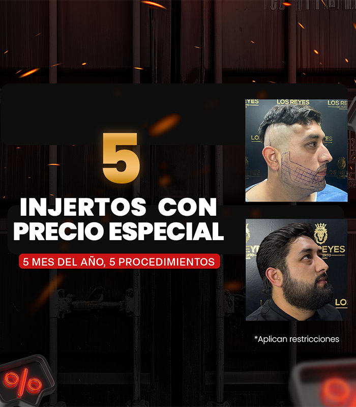 Promoción de 5 injertos de barba o cabello, con precio especial